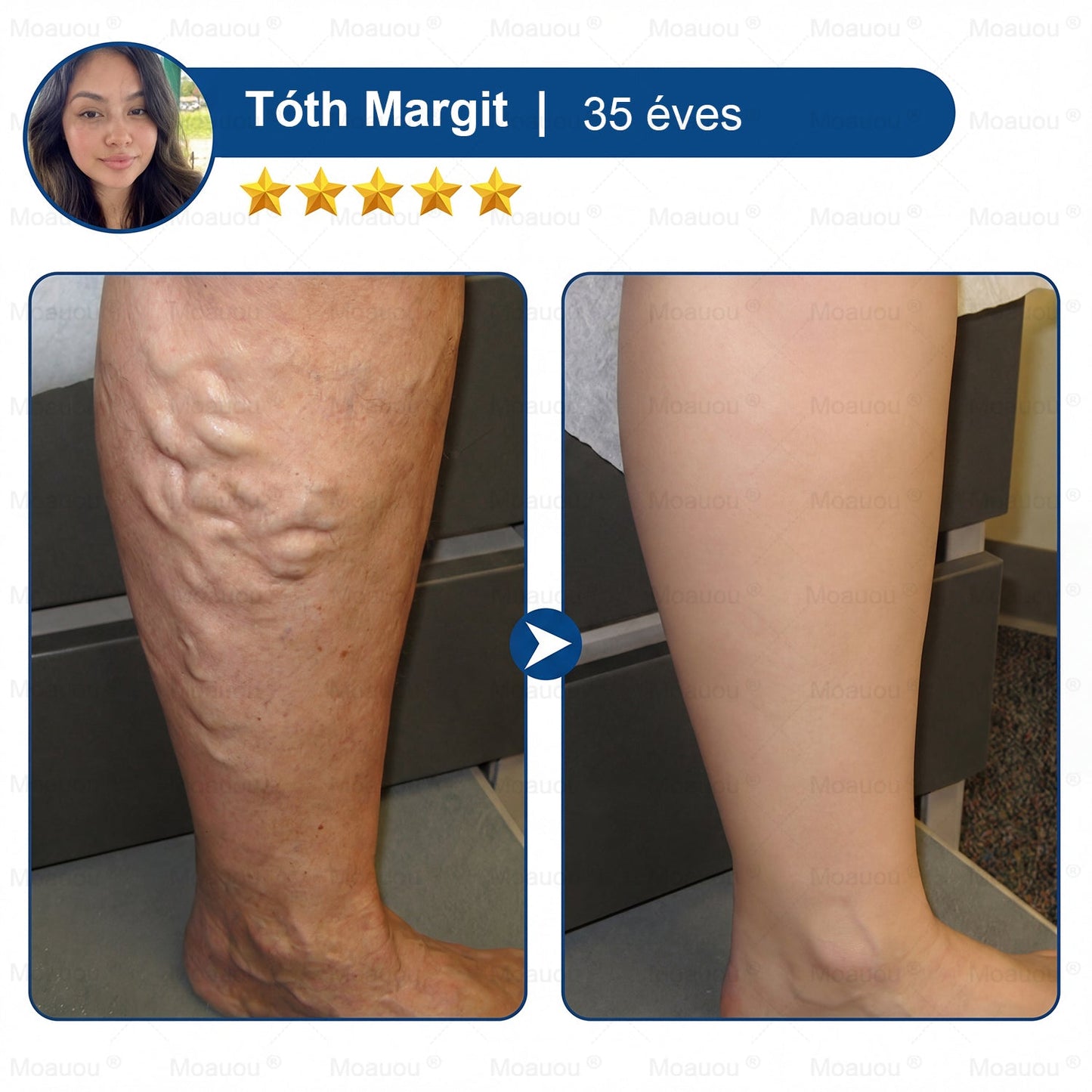 🇸🇰👨‍⚕️✅ Moauou® GHK-Cu™ Mikroihličková regeneračná náplasť ⚡ Okamžitá úľava, dlhotrvajúce výsledky – VEĽKÁ AKCIA!