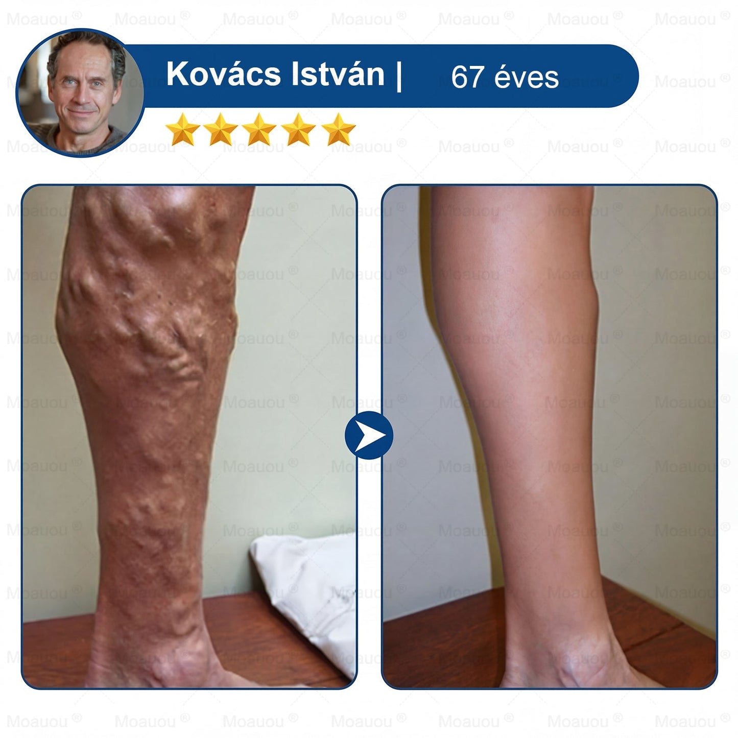 🇸🇰👨‍⚕️✅ Moauou® GHK-Cu™ Mikroihličková regeneračná náplasť ⚡ Okamžitá úľava, dlhotrvajúce výsledky – VEĽKÁ AKCIA!