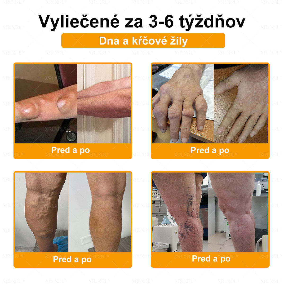 🏥𝑋𝑅𝐿𝑋𝑅𝐿® Krem przeciwbólowy i regenerujący kości z toksyną botulinową i jadem pszczelim 🏆(Specjalnie dla osób starszych, polecany przez EFORT)