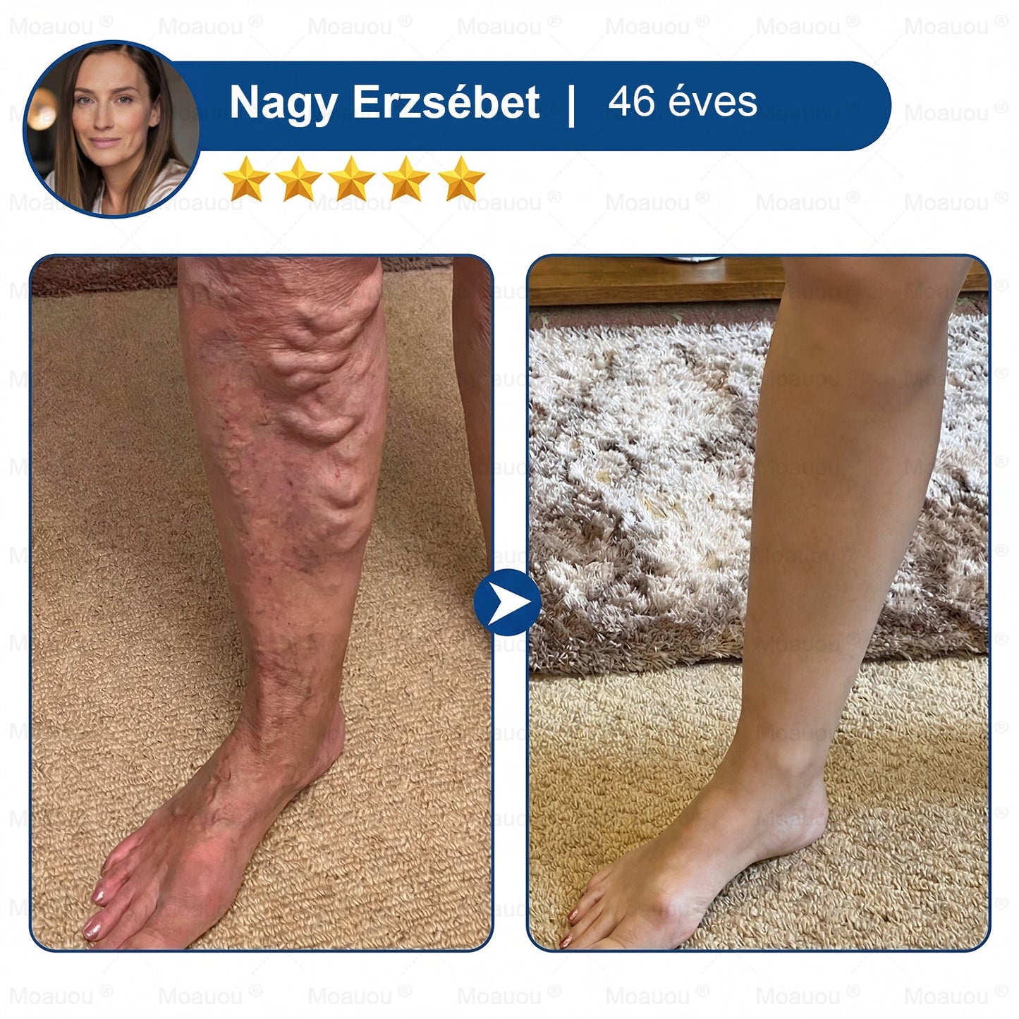 🇸🇰👨‍⚕️✅ Moauou® GHK-Cu™ Mikroihličková regeneračná náplasť ⚡ Okamžitá úľava, dlhotrvajúce výsledky – VEĽKÁ AKCIA!